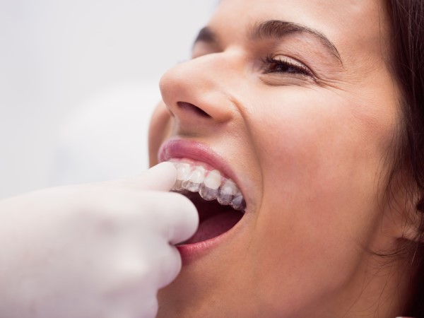 Aparat dentar invizibil 