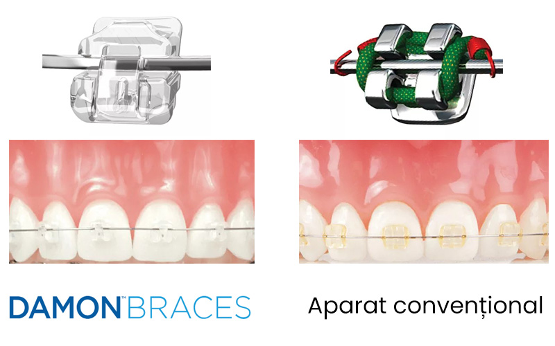 aparat dental autoligaturant