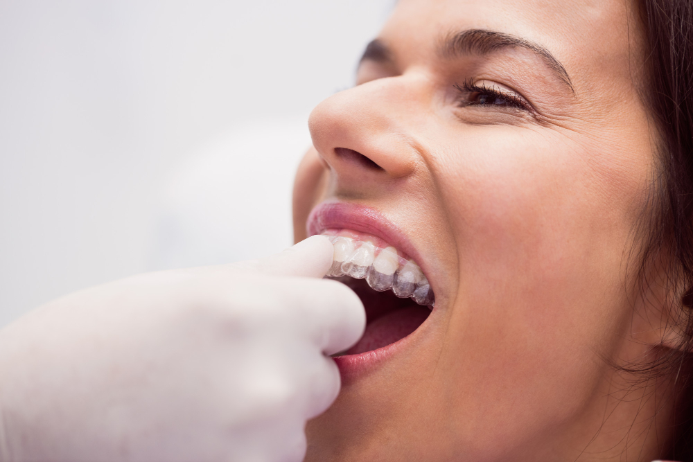 aparat dental invizibil