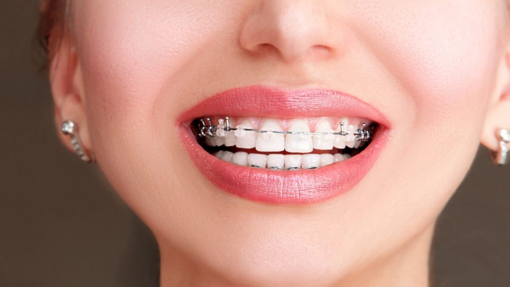aparat dental metalic